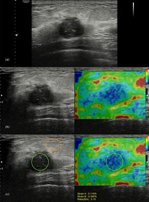 Added Value of a New Strain Elastography Technique in Conventional Ultrasound for the Diagnosis of Breast Masses: A Prospective Multicenter Study